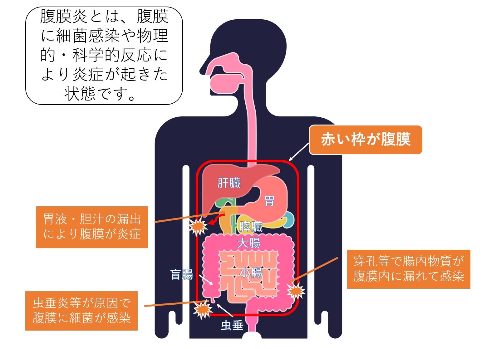 腹膜炎の原因は何ですか?