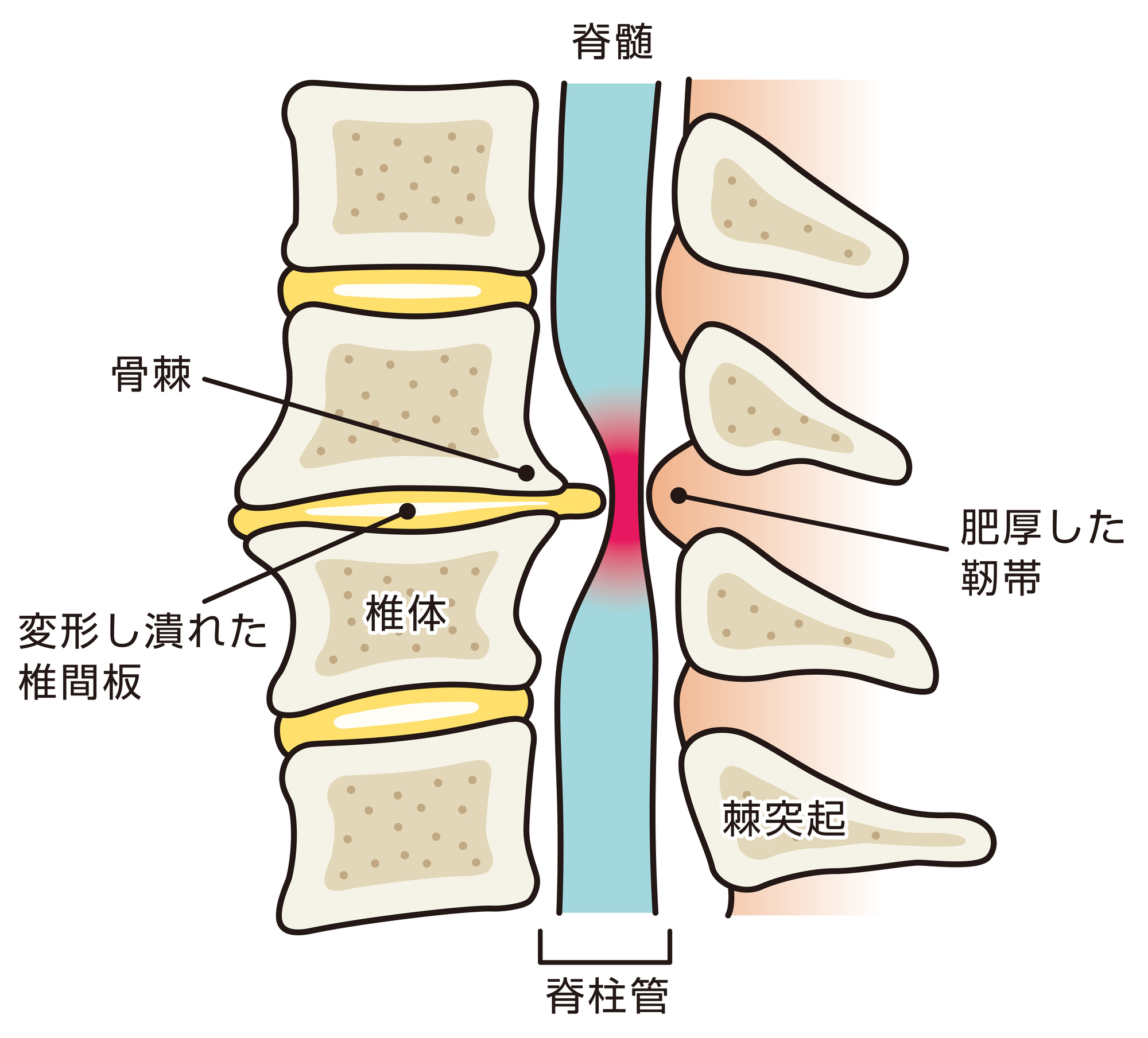 腰椎変性